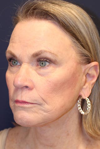 Facelift Before & After Gallery - Patient 731045 - Image 4
