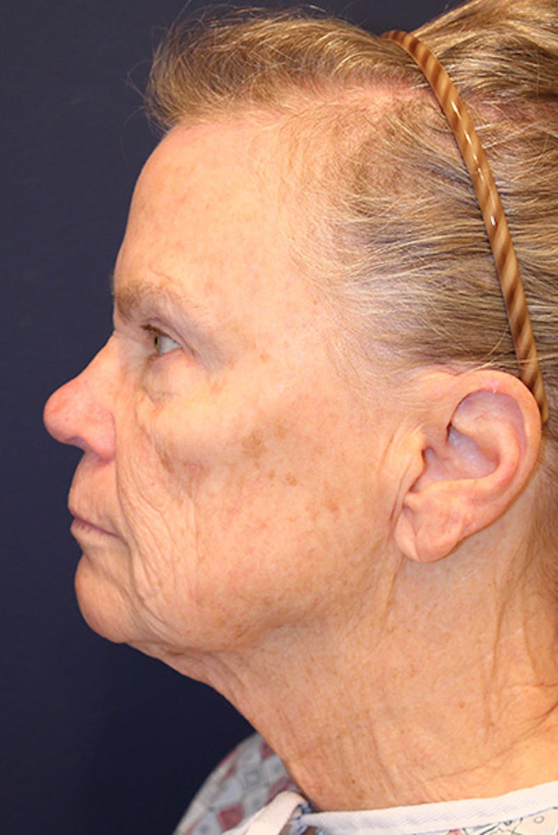 Facelift Before & After Gallery - Patient 731045 - Image 5