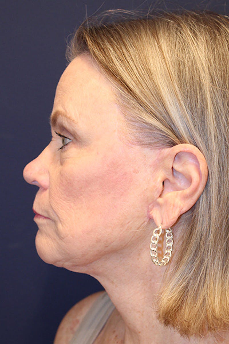 Facelift Before & After Gallery - Patient 731045 - Image 6