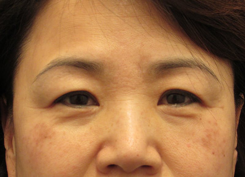 Eyelid Surgery Before & After Gallery - Patient 194040 - Image 1