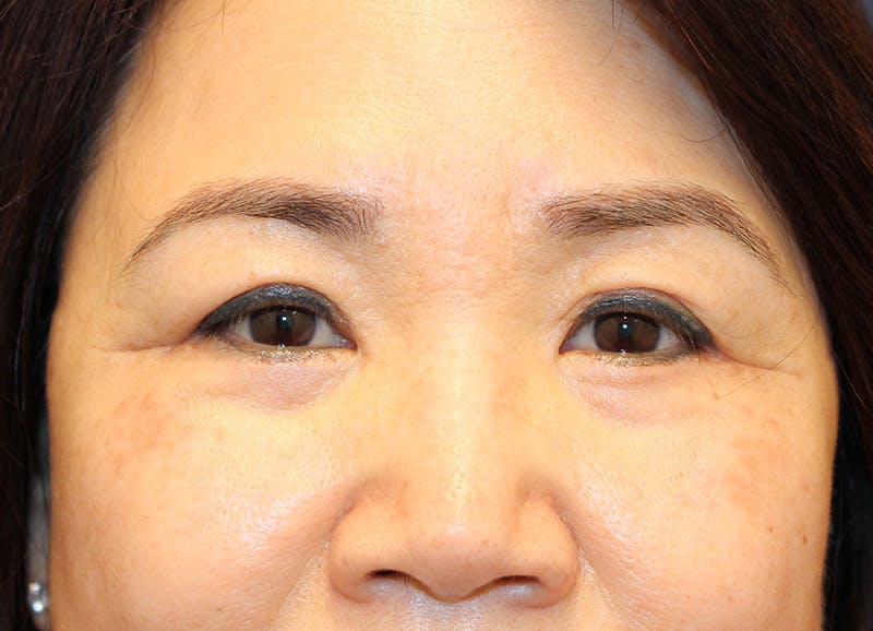 Eyelid Surgery Before & After Gallery - Patient 194040 - Image 2