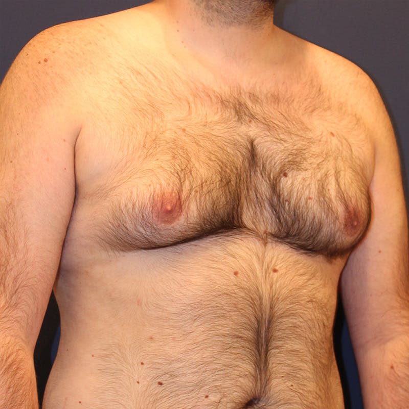 Male Breast Reduction/Gynecomastia Before & After Gallery - Patient 302194 - Image 2