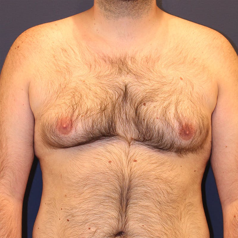 Male Breast Reduction/Gynecomastia Before & After Gallery - Patient 302194 - Image 1