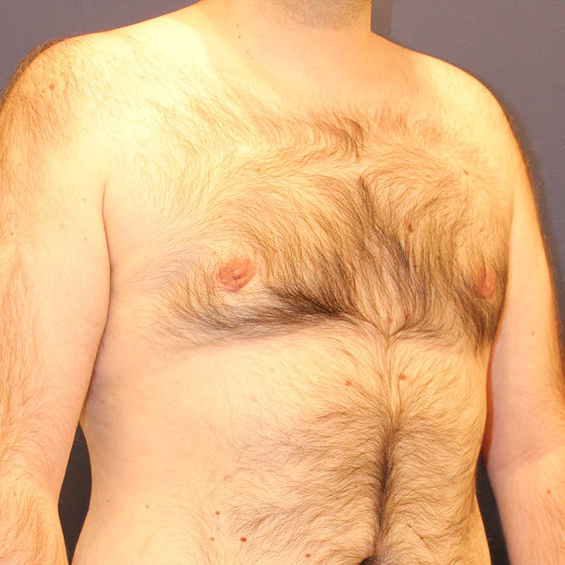 Male Breast Reduction/Gynecomastia Before & After Gallery - Patient 302194 - Image 3