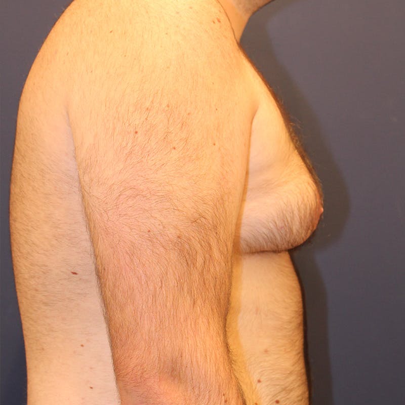 Male Breast Reduction/Gynecomastia Before & After Gallery - Patient 302194 - Image 4