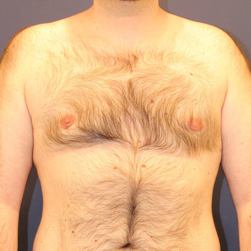 Male Breast Reduction/Gynecomastia Before & After Gallery - Patient 302194 - Image 6