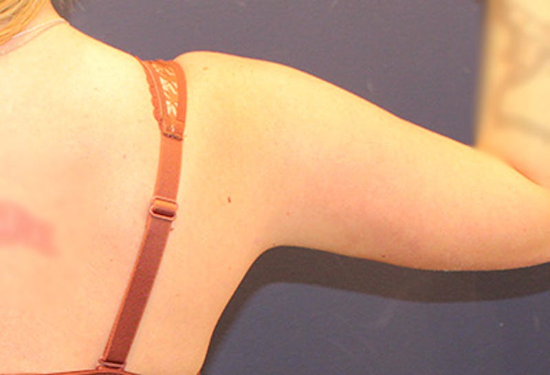 Liposuction Before & After Gallery - Patient 356486 - Image 4