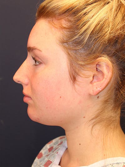Liposuction Before & After Gallery - Patient 336168 - Image 1