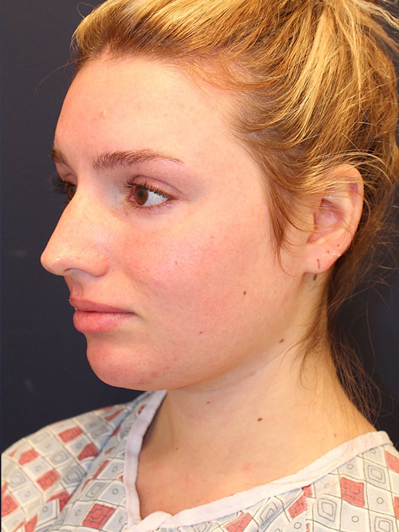 Liposuction Before & After Gallery - Patient 336168 - Image 3