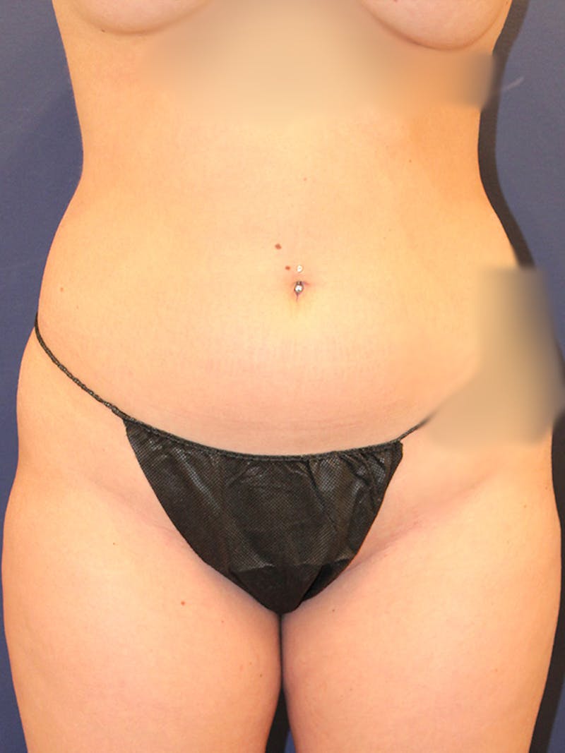 Liposuction Before & After Gallery - Patient 395876 - Image 1