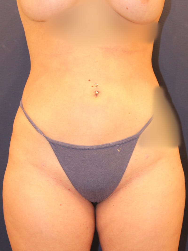 Liposuction Before & After Gallery - Patient 395876 - Image 2