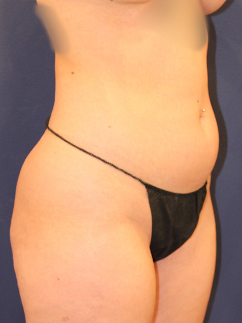 Liposuction Before & After Gallery - Patient 395876 - Image 3