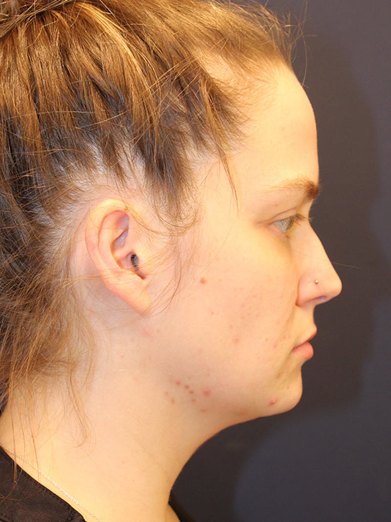 Sofwave Before & After Gallery - Patient 230234 - Image 3