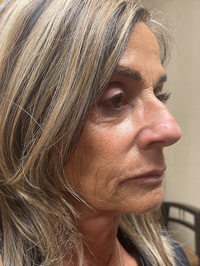 Injectables Before & After Gallery - Patient 279725 - Image 1