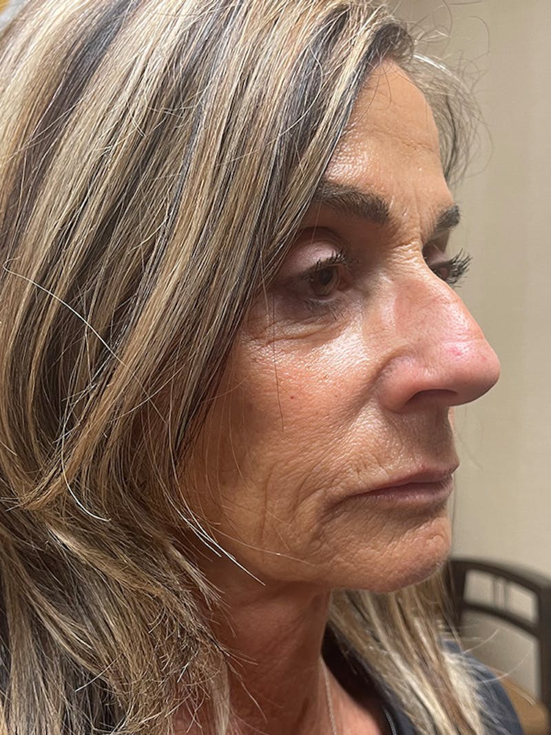 Injectables Before & After Gallery - Patient 279725 - Image 1