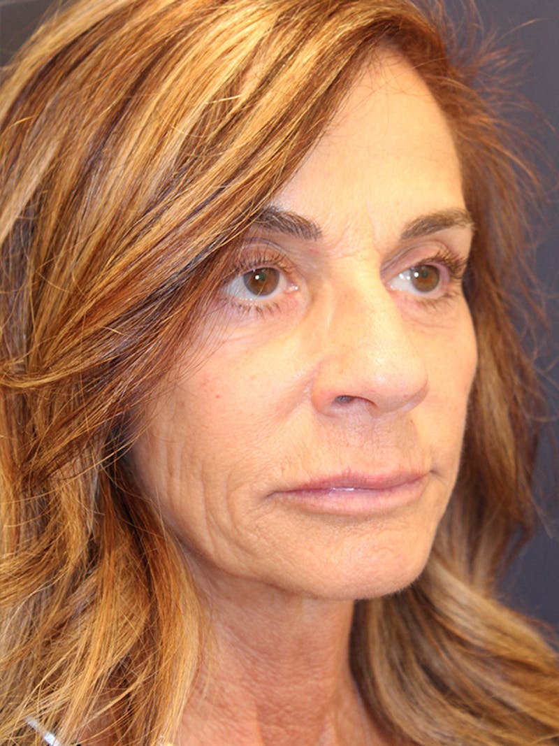 Injectables Before & After Gallery - Patient 279725 - Image 2