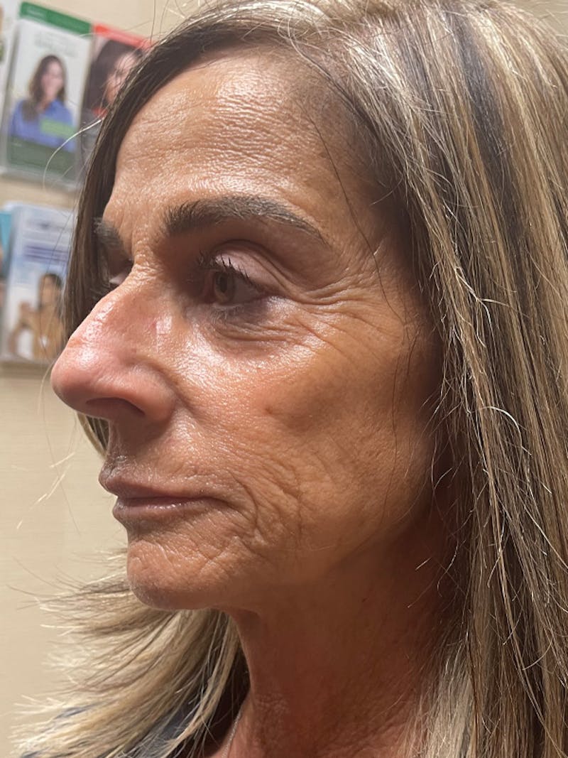 Injectables Before & After Gallery - Patient 279725 - Image 3
