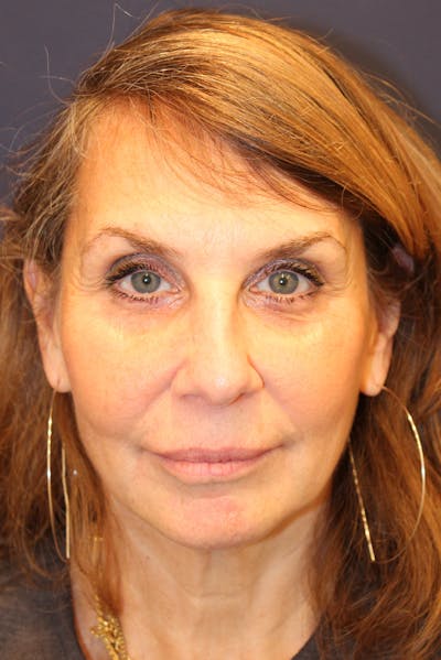 Sofwave Before & After Gallery - Patient 761383 - Image 1