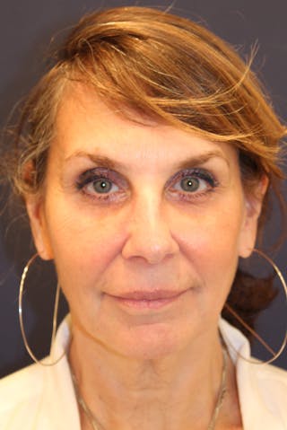 Sofwave Before & After Gallery - Patient 761383 - Image 2