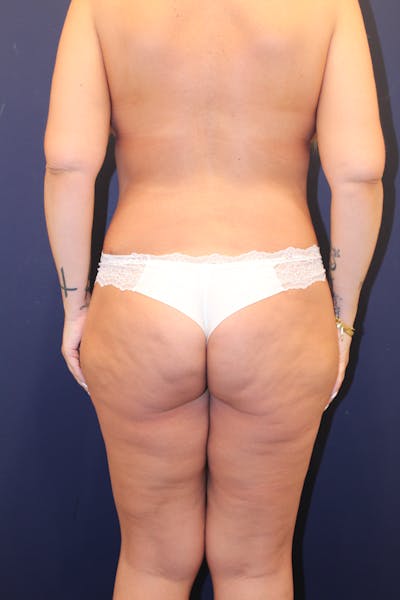 Tummy Tuck Before & After Gallery - Patient 131225 - Image 2