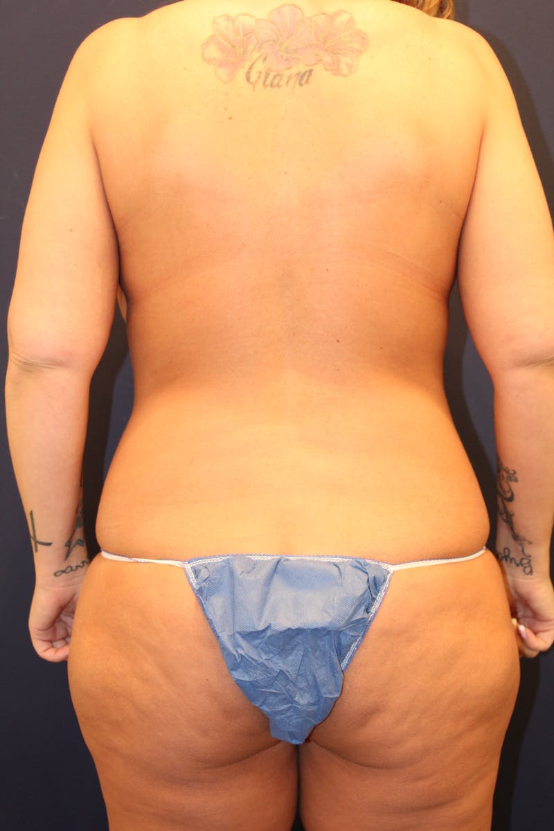 Liposuction Before & After Gallery - Patient 237248 - Image 1