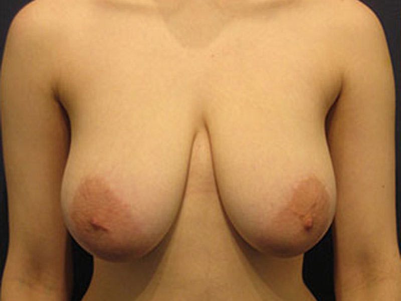 Breast Lift Before & After Gallery - Patient 174146592 - Image 1