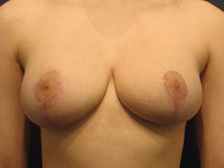 Breast Lift Before & After Gallery - Patient 174146592 - Image 2