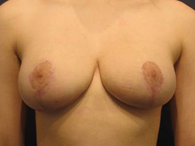 Breast Lift Before & After Gallery - Patient 174146592 - Image 2