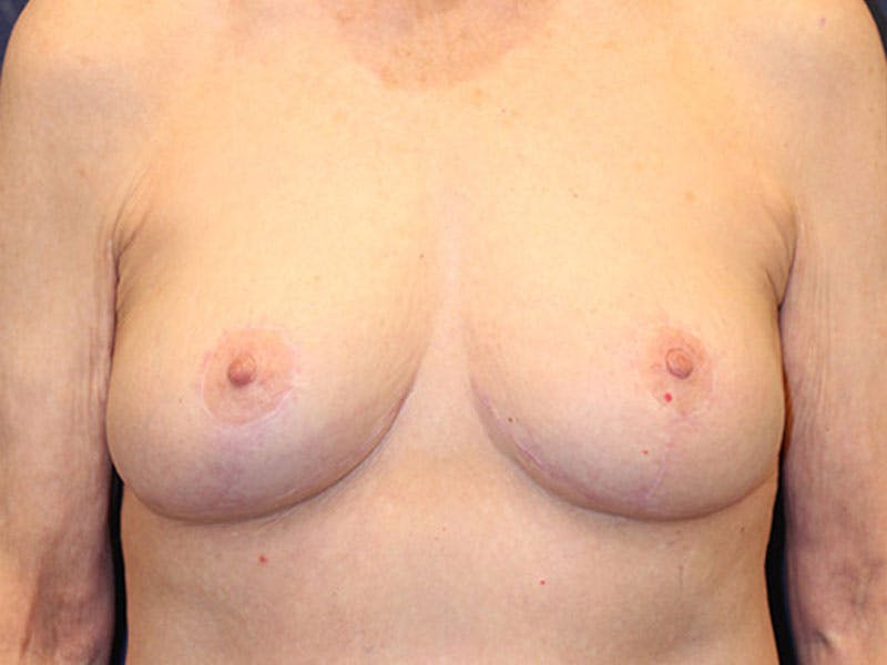 Breast Lift Before & After Gallery - Patient 174147700 - Image 2
