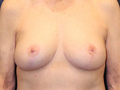 Breast Lift Before & After Gallery - Patient 174147700 - Image 2