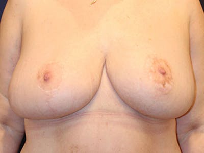 Breast Lift Before & After Gallery - Patient 132336 - Image 2