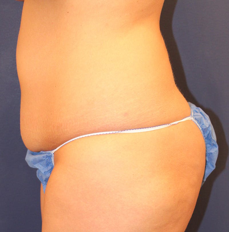 Tummy Tuck Before & After Gallery - Patient 104389 - Image 5