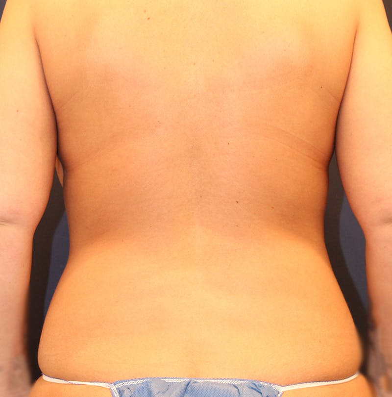 Tummy Tuck Before & After Gallery - Patient 104389 - Image 7