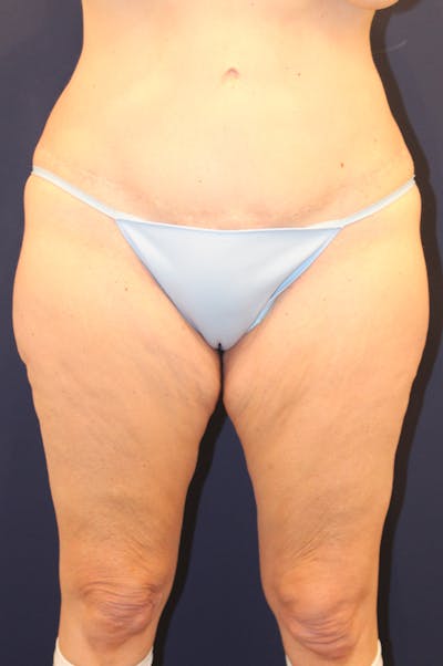 Massive Weight Loss Before & After Gallery - Patient 208403 - Image 1
