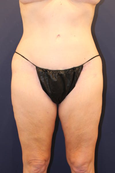 Thigh Lift Before & After Gallery - Patient 408997 - Image 2