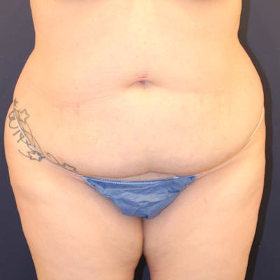 Tummy Tuck Before & After Gallery - Patient 369644 - Image 1