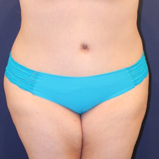 Tummy Tuck Before & After Gallery - Patient 369644 - Image 2