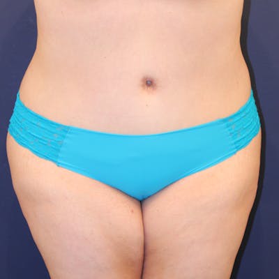Tummy Tuck Before & After Gallery - Patient 369644 - Image 2