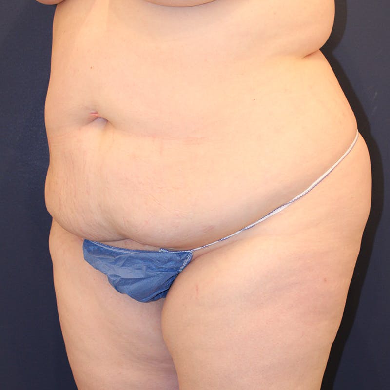 Tummy Tuck Before & After Gallery - Patient 369644 - Image 3