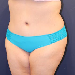 Tummy Tuck Before & After Gallery - Patient 369644 - Image 4