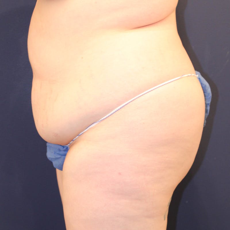 Tummy Tuck Before & After Gallery - Patient 369644 - Image 5