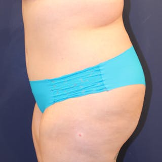 Tummy Tuck Before & After Gallery - Patient 369644 - Image 6