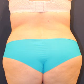Tummy Tuck Before & After Gallery - Patient 369644 - Image 8