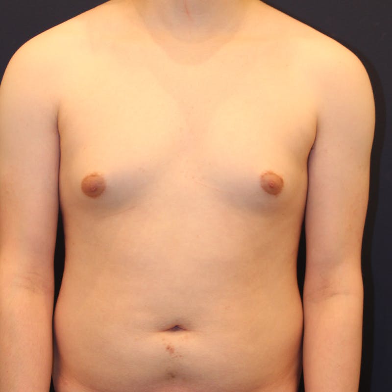 Male Breast Reduction/Gynecomastia Before & After Gallery - Patient 184009 - Image 1