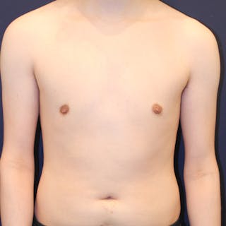 Male Breast Reduction/Gynecomastia Before & After Gallery - Patient 184009 - Image 2