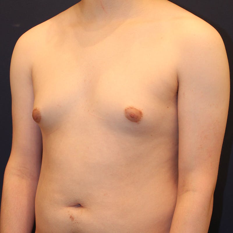 Male Breast Reduction/Gynecomastia Before & After Gallery - Patient 184009 - Image 3