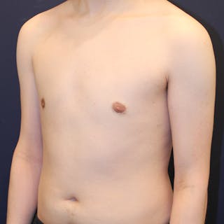 Male Breast Reduction/Gynecomastia Before & After Gallery - Patient 184009 - Image 4