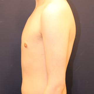 Male Breast Reduction/Gynecomastia Before & After Gallery - Patient 184009 - Image 6