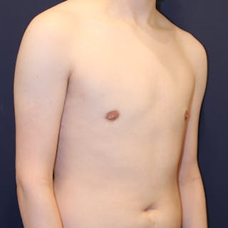 Male Breast Reduction/Gynecomastia Before & After Gallery - Patient 184009 - Image 8