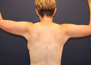 Arm Lift Before & After Gallery - Patient 465969 - Image 4